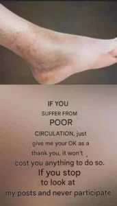 How to Improve Leg Circulation
